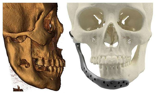 UFU faz 1ª cirurgia de troca de articulação temporomandibular pelo SUS