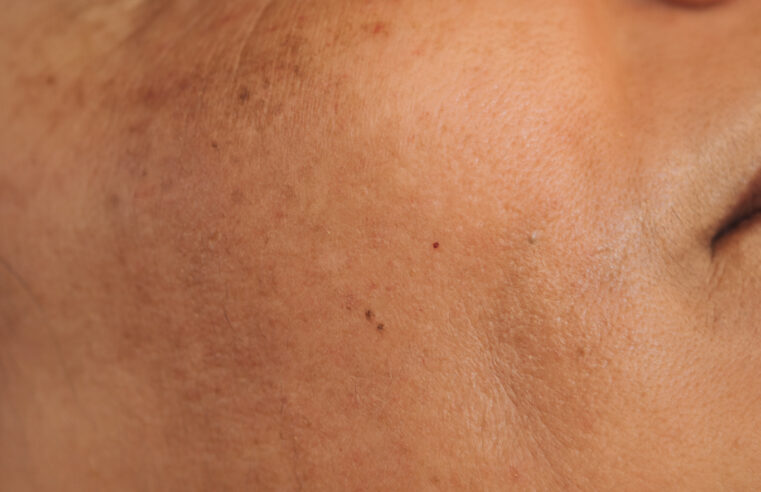 Manchas que vão além do espelho: o desafio das mulheres com Melasma